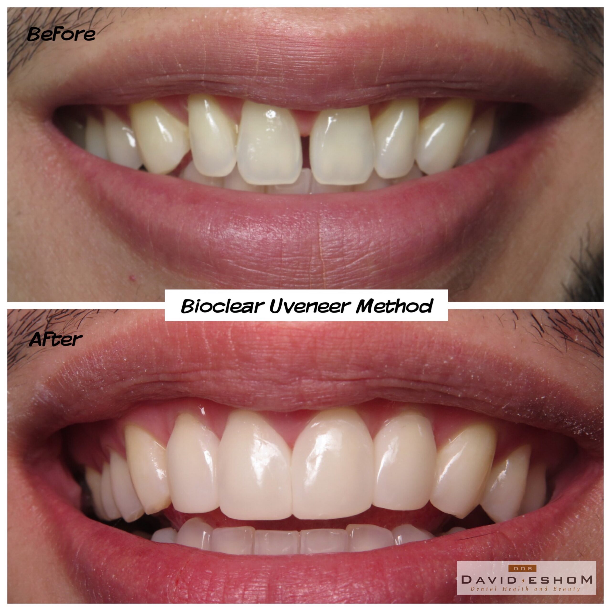 Bioclear