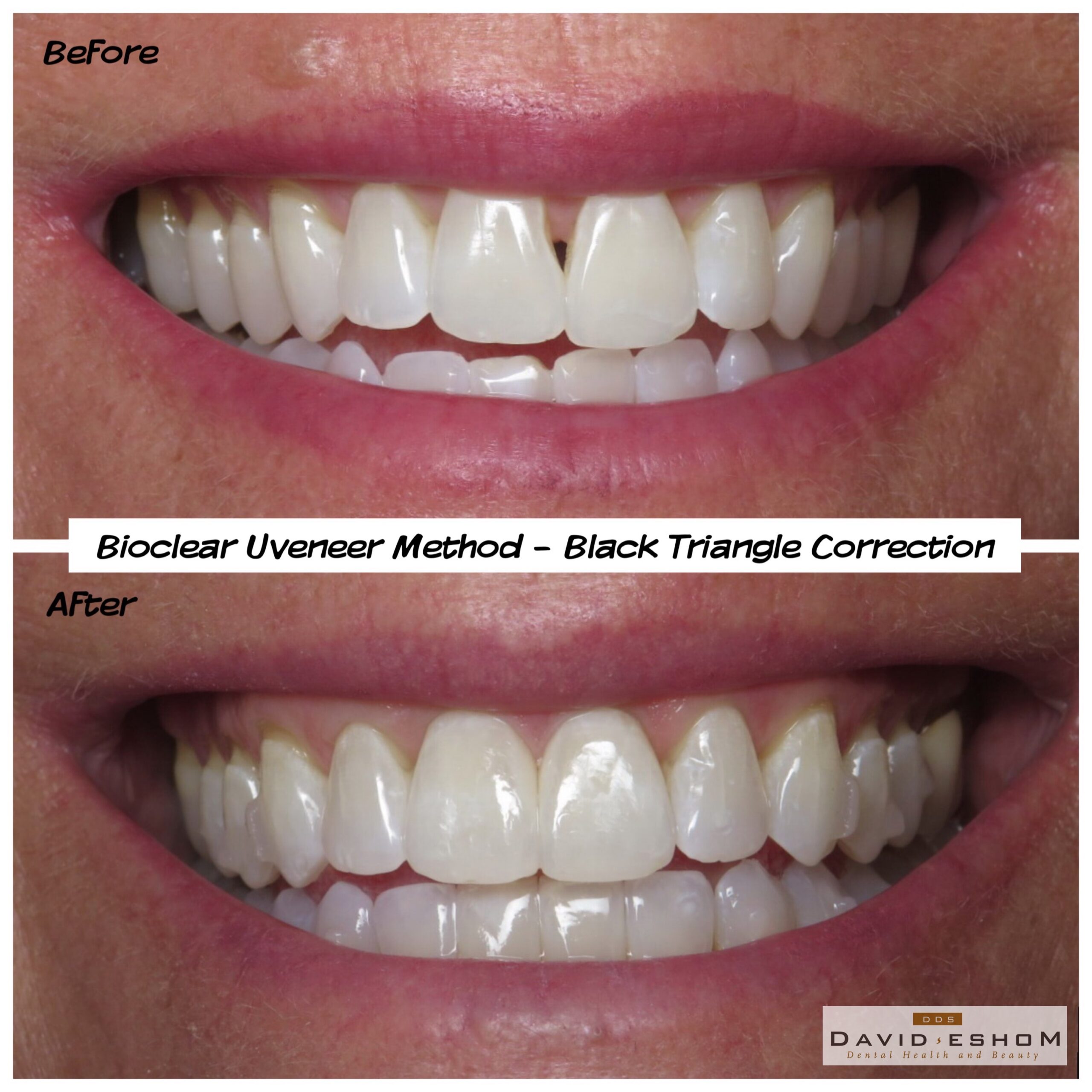 Bioclear