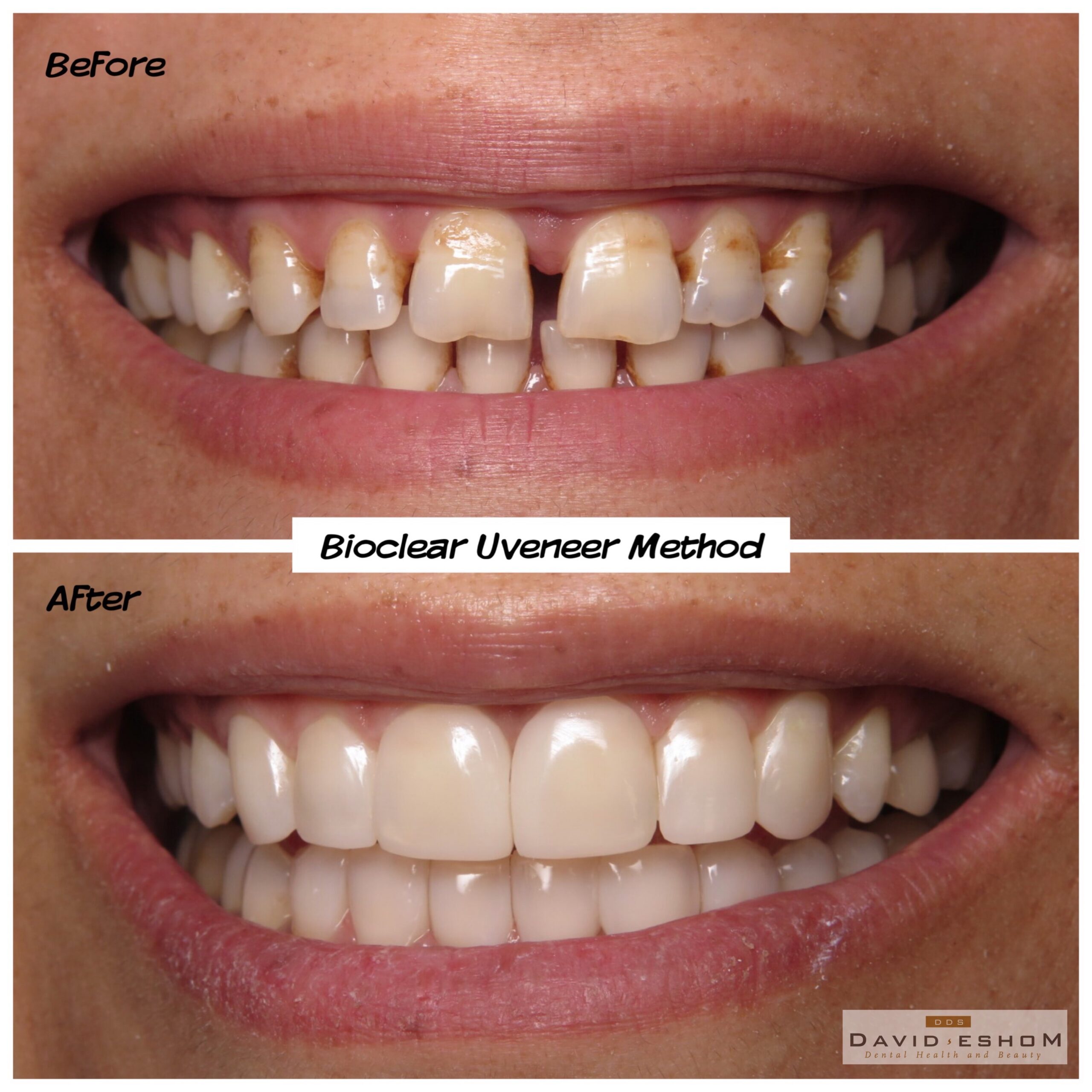 Bioclear