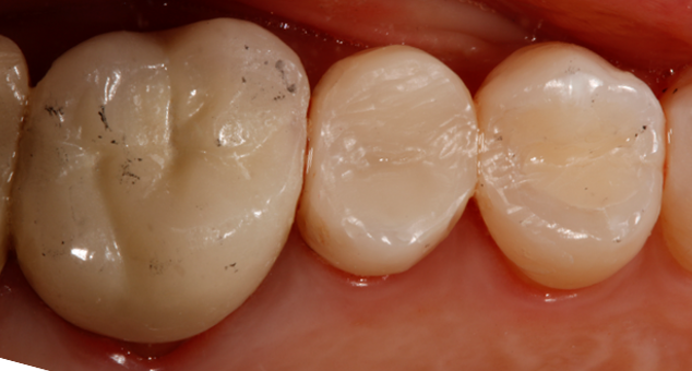 Bioclear