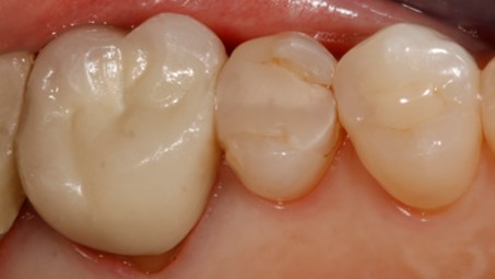 Bioclear