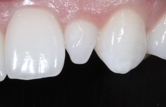 Bioclear