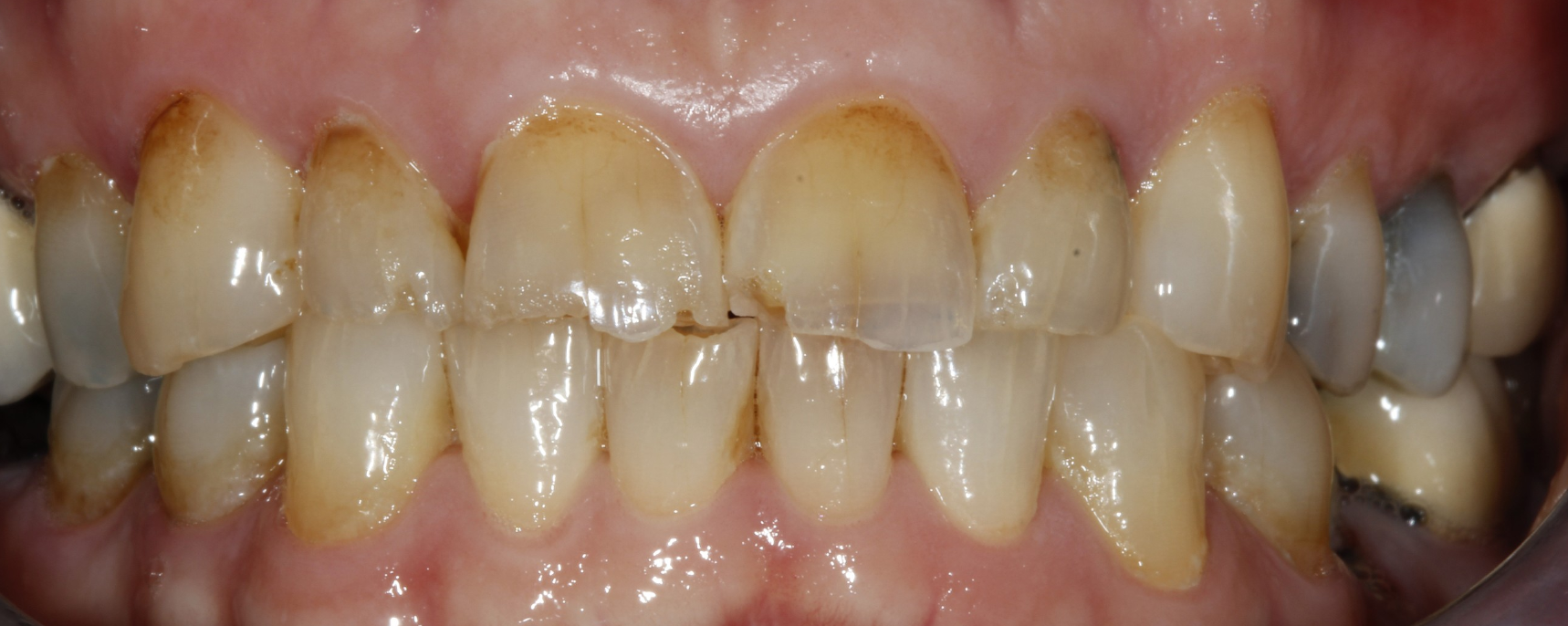 Bioclear