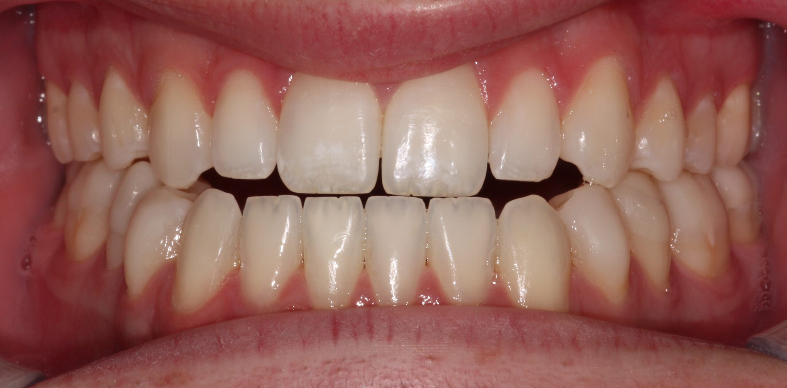 Bioclear