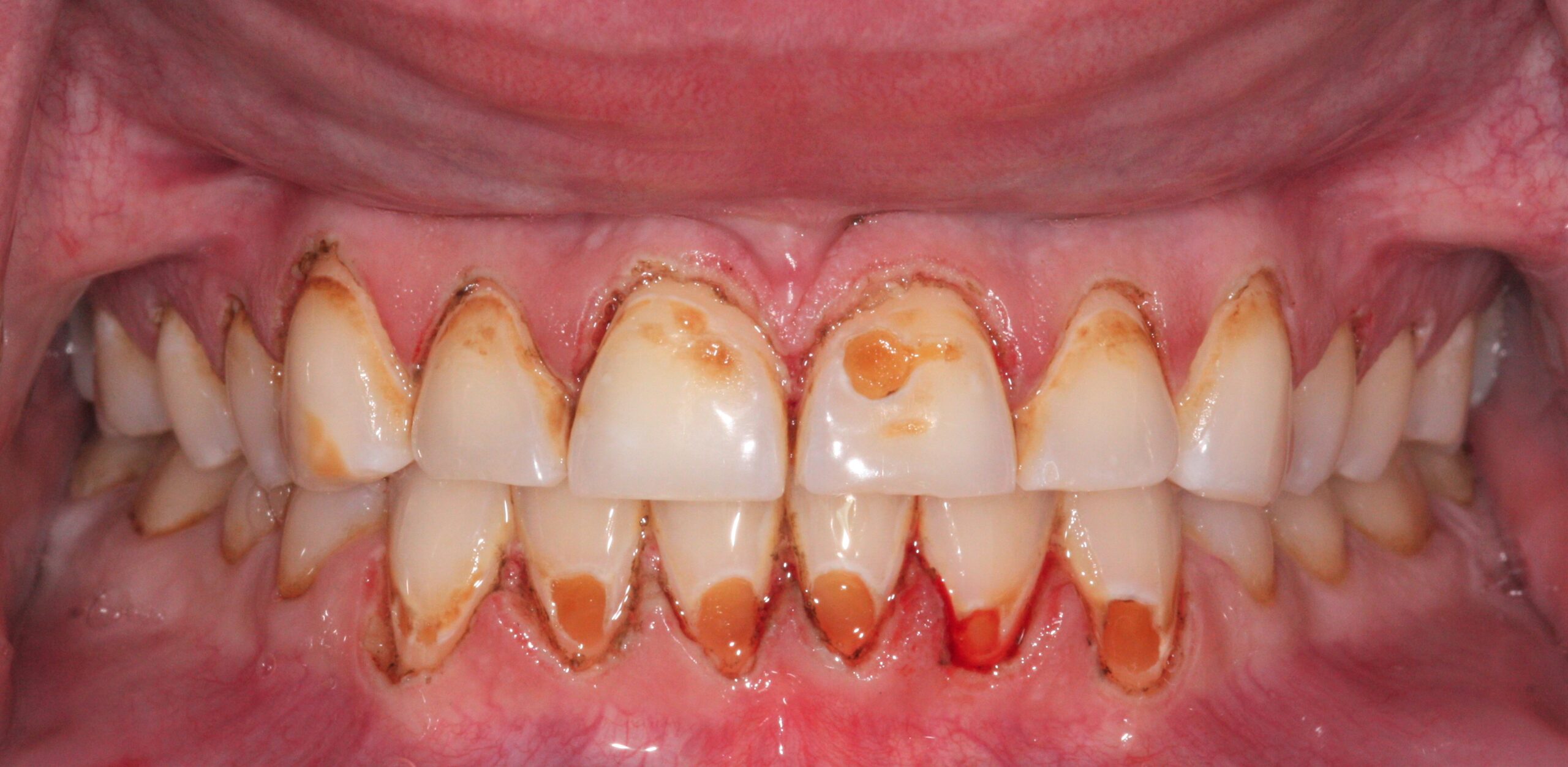 Bioclear