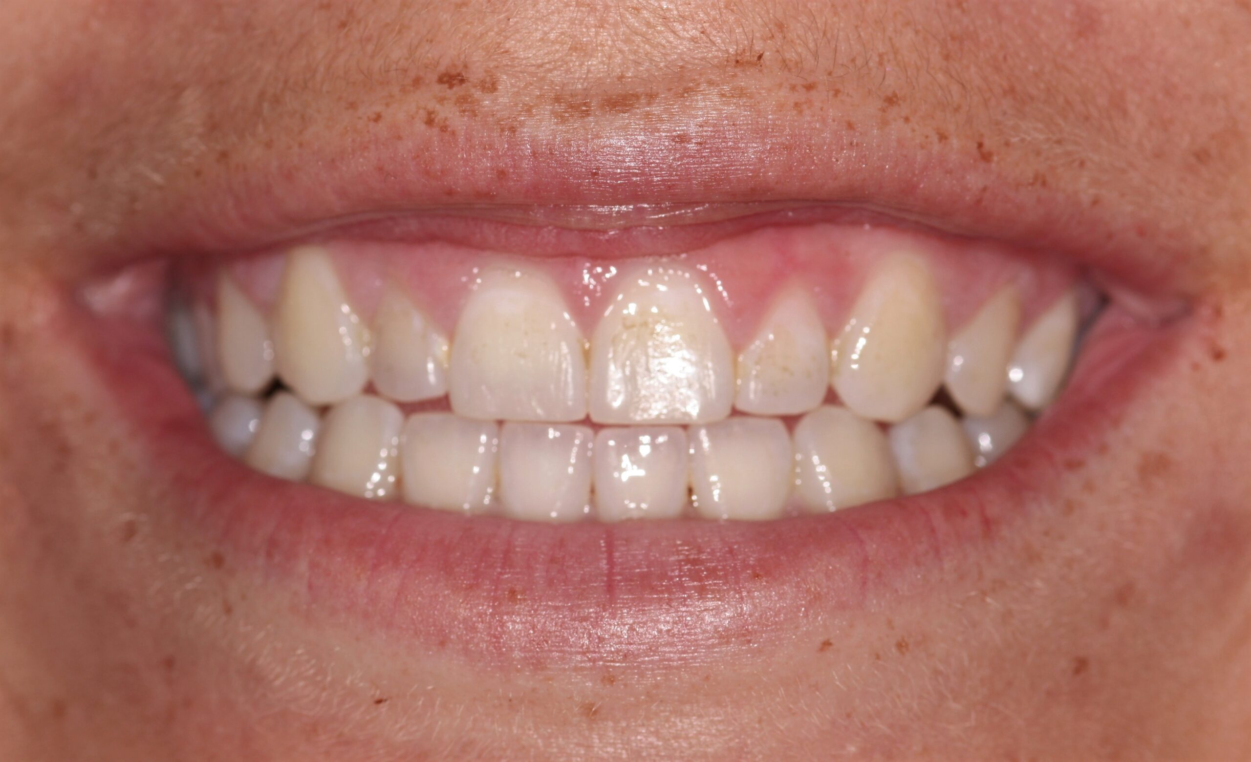 Bioclear