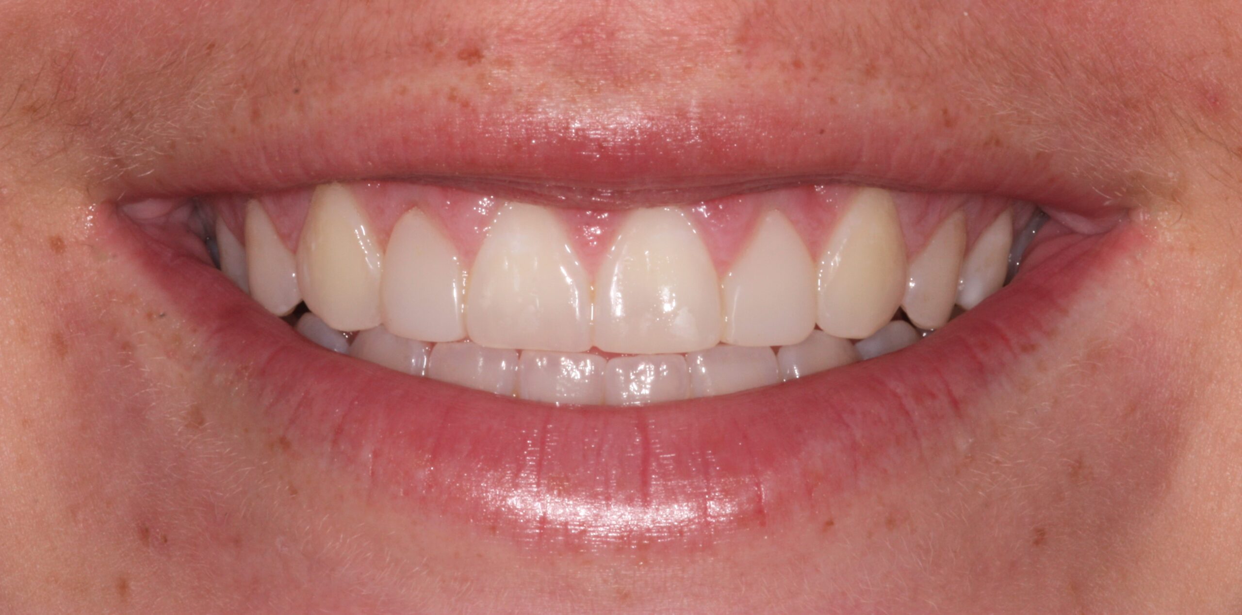 Bioclear