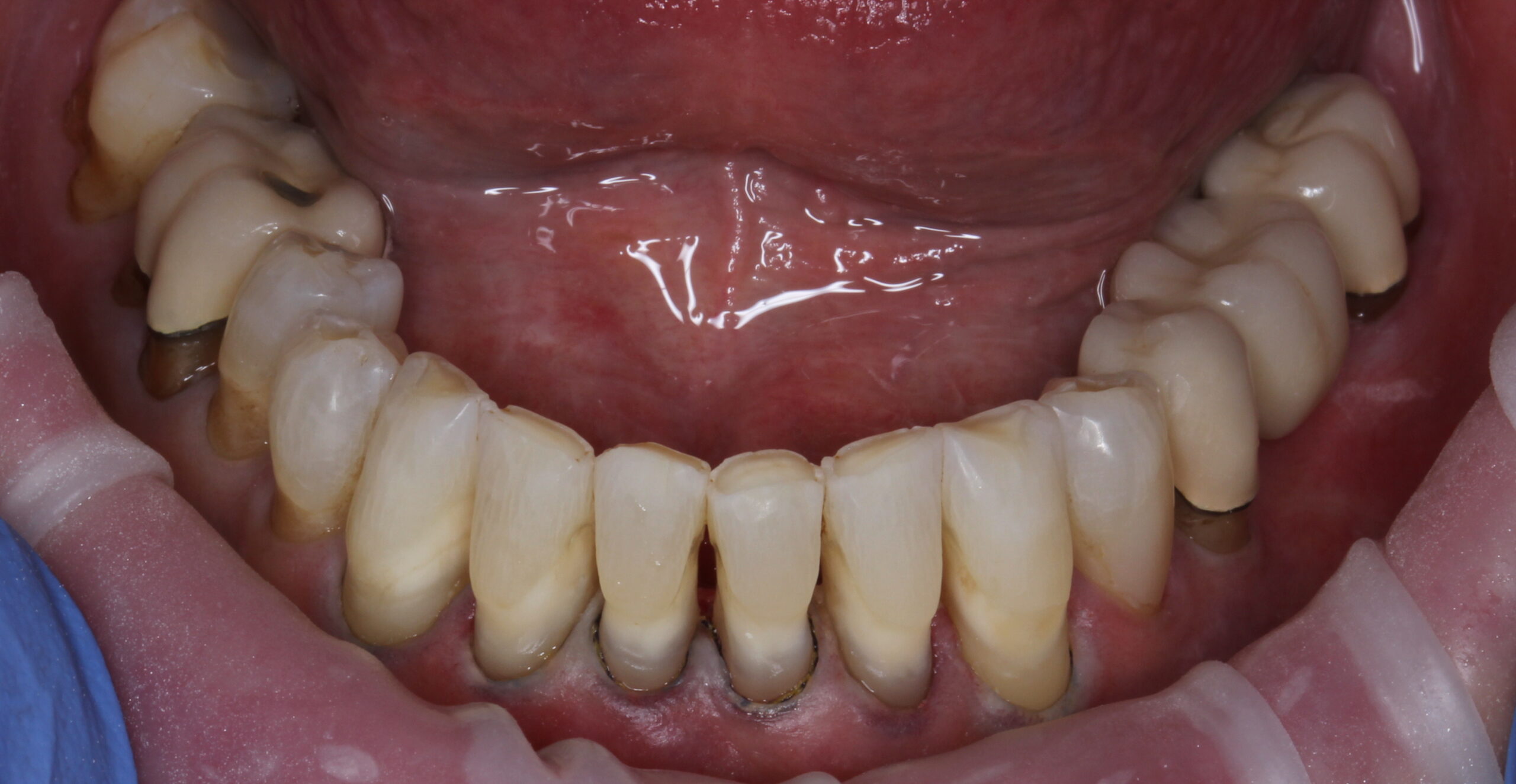Bioclear