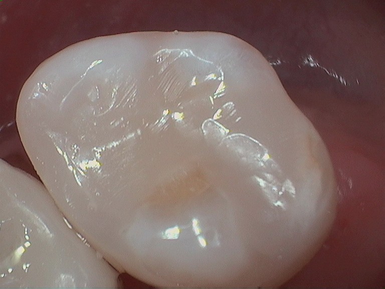 Bioclear
