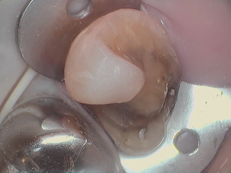 Bioclear