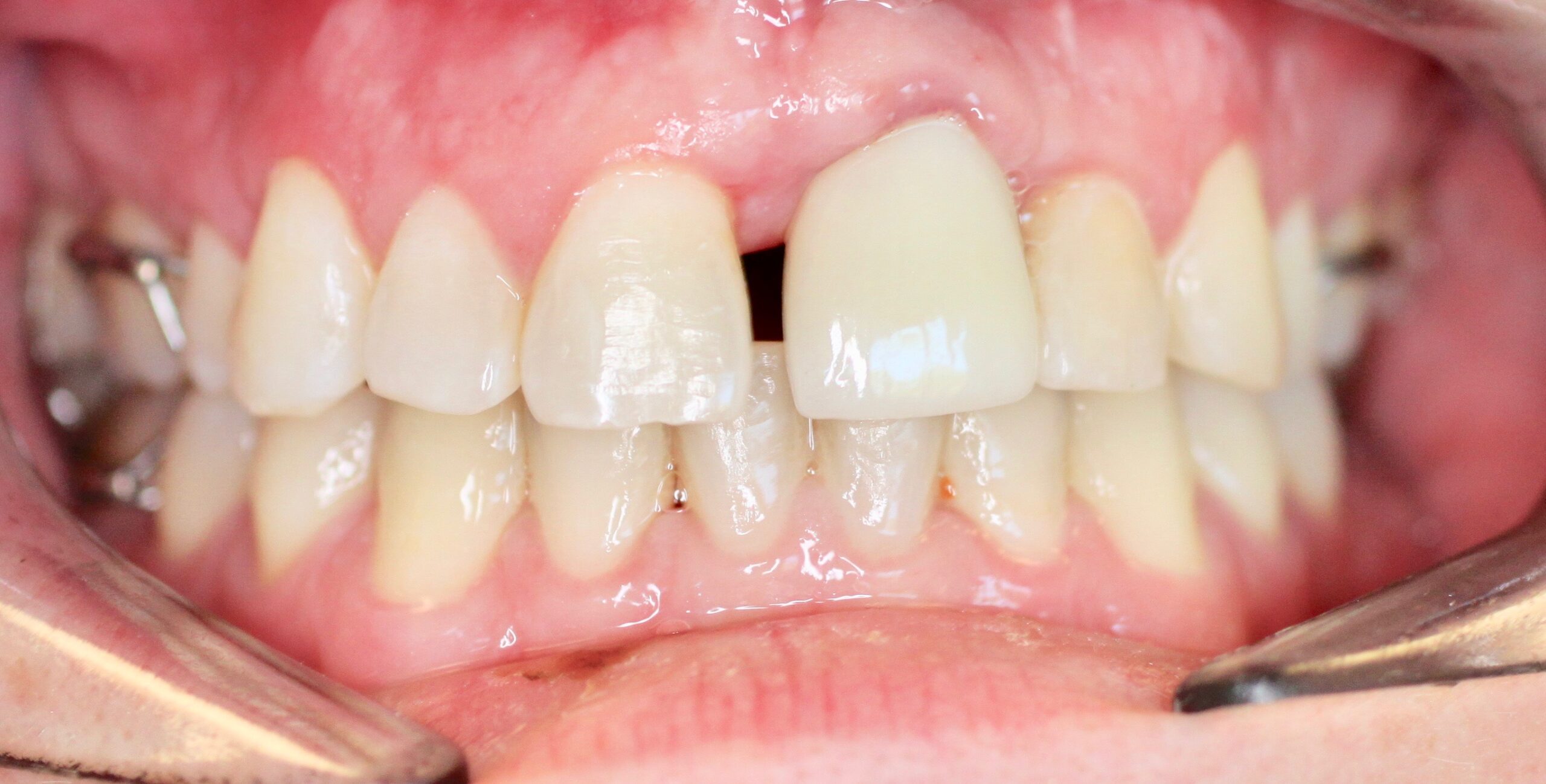 Bioclear