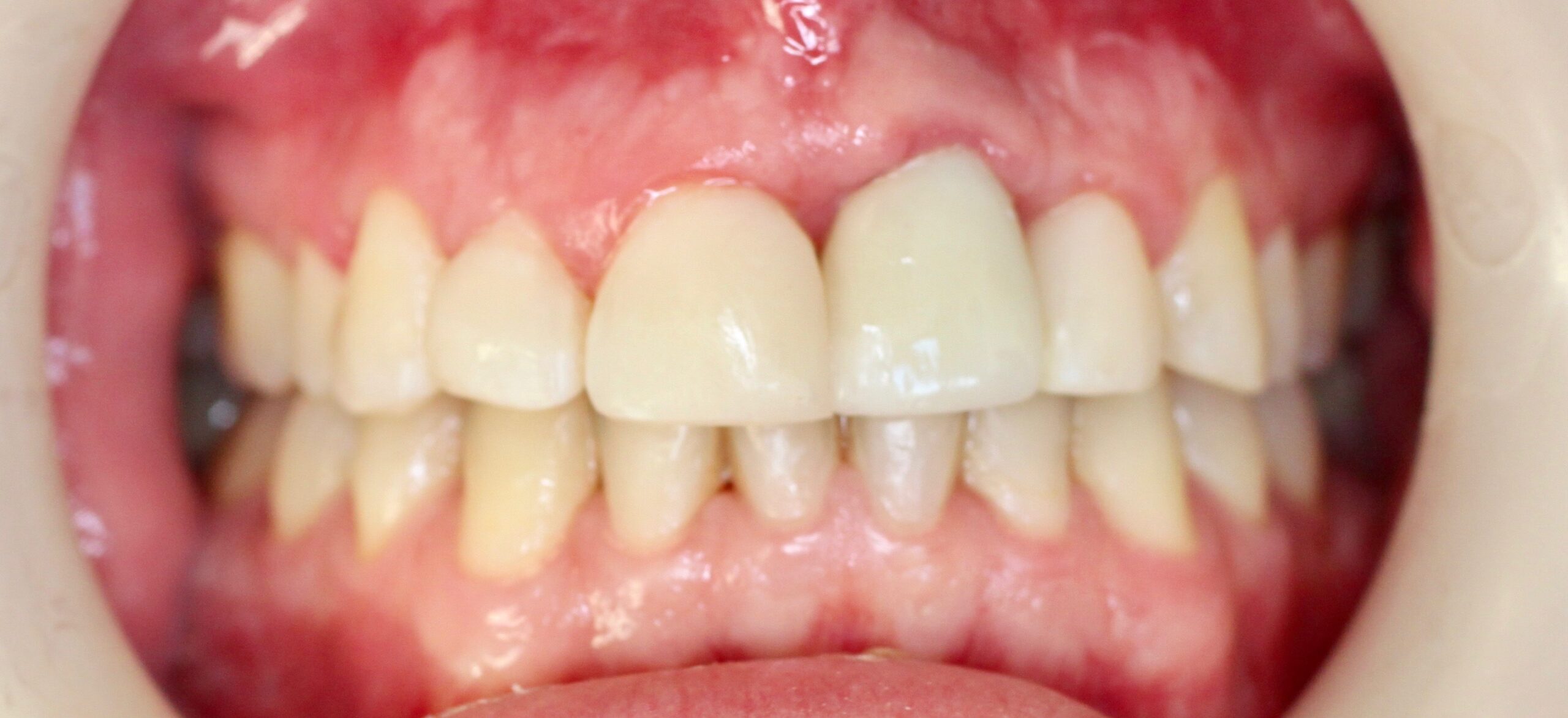 Bioclear