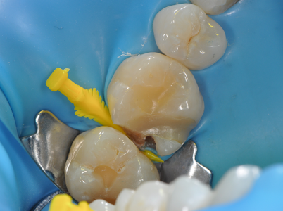 Bioclear