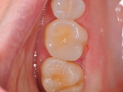 Bioclear