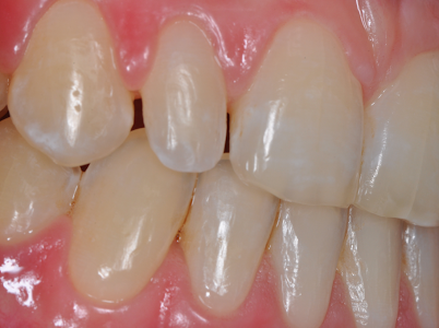 Bioclear