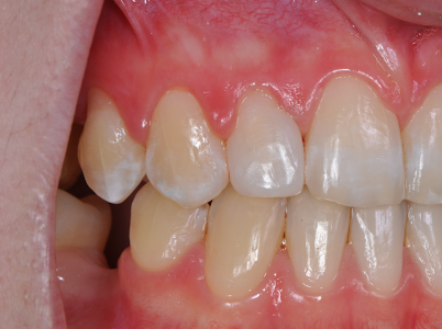 Bioclear