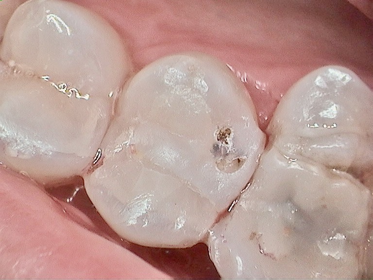Bioclear