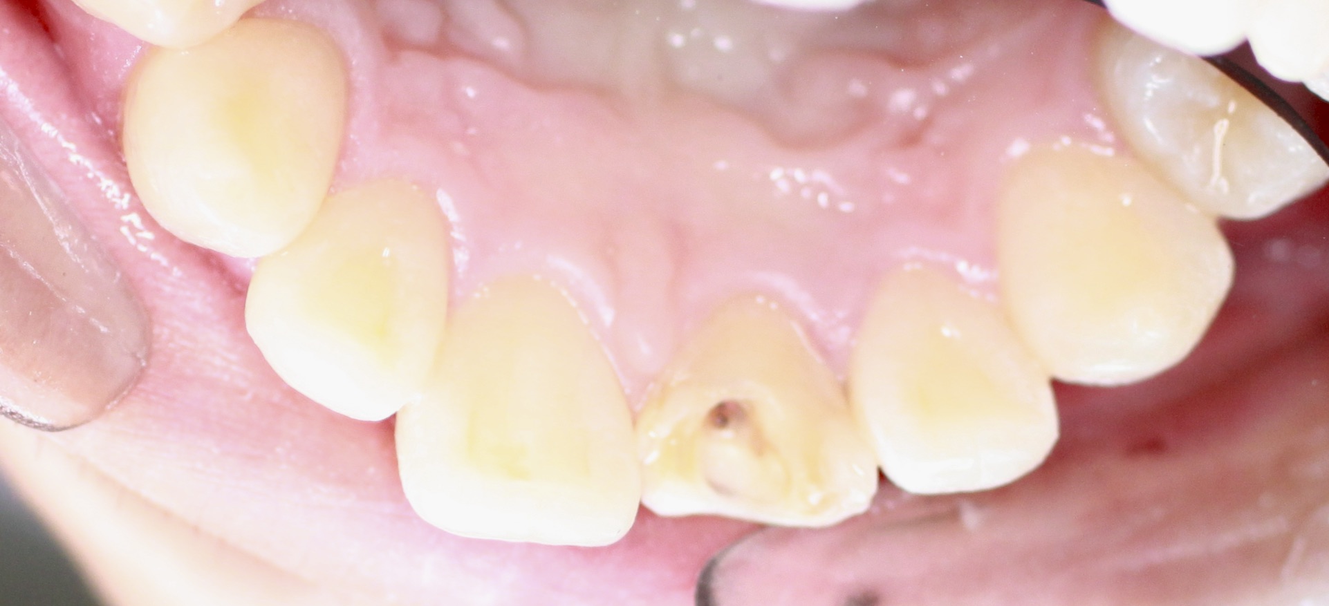 Bioclear