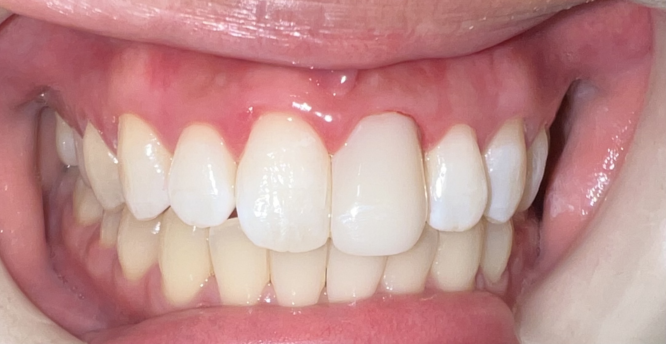 Bioclear