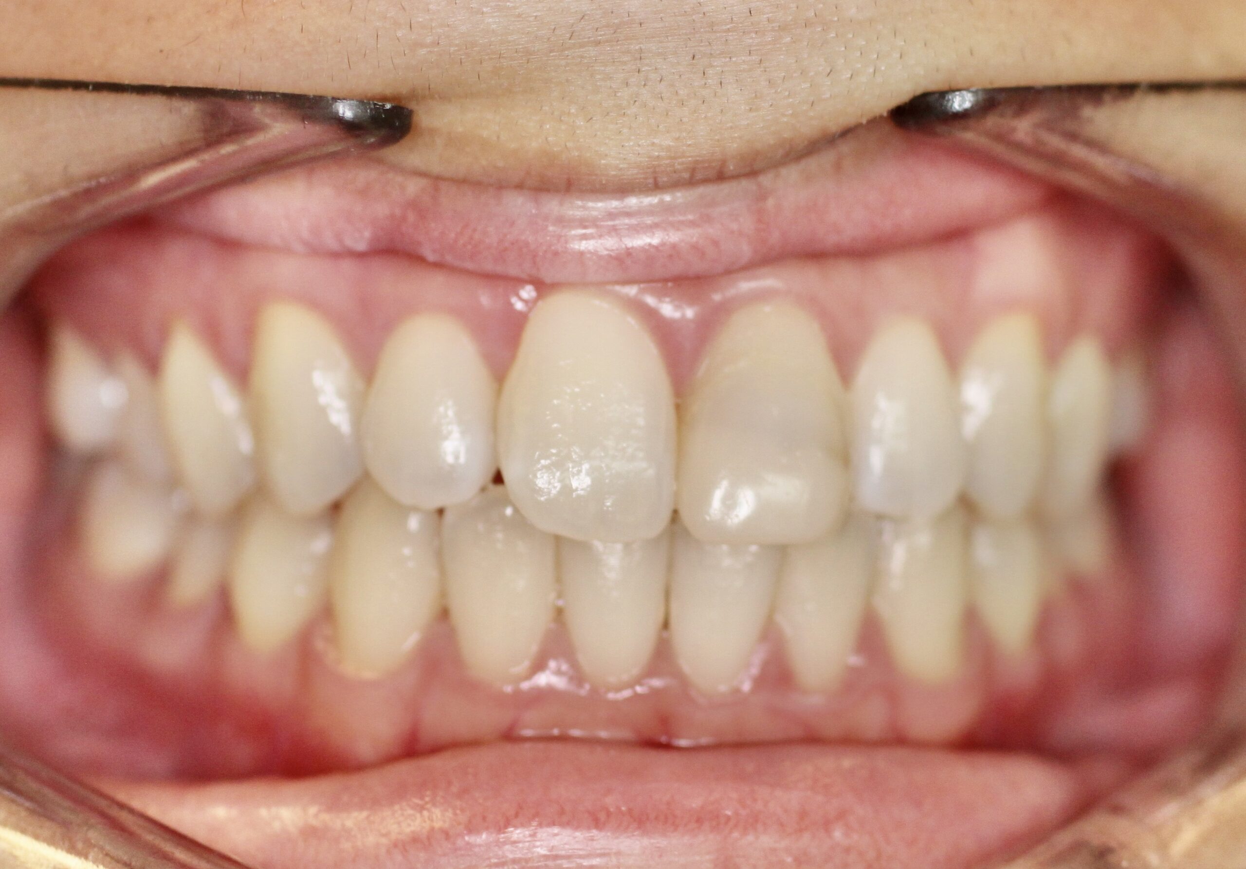 Bioclear