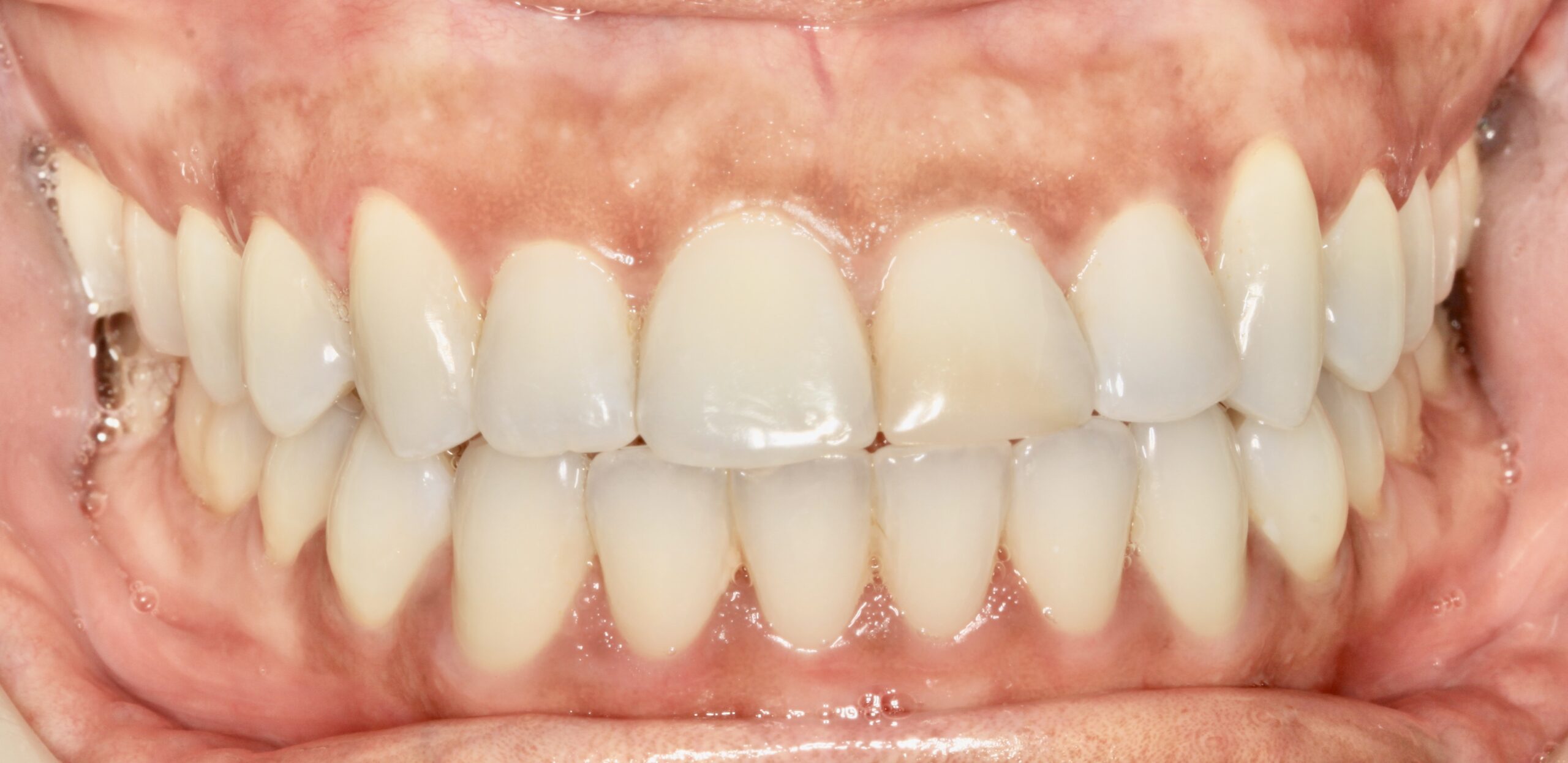 Bioclear