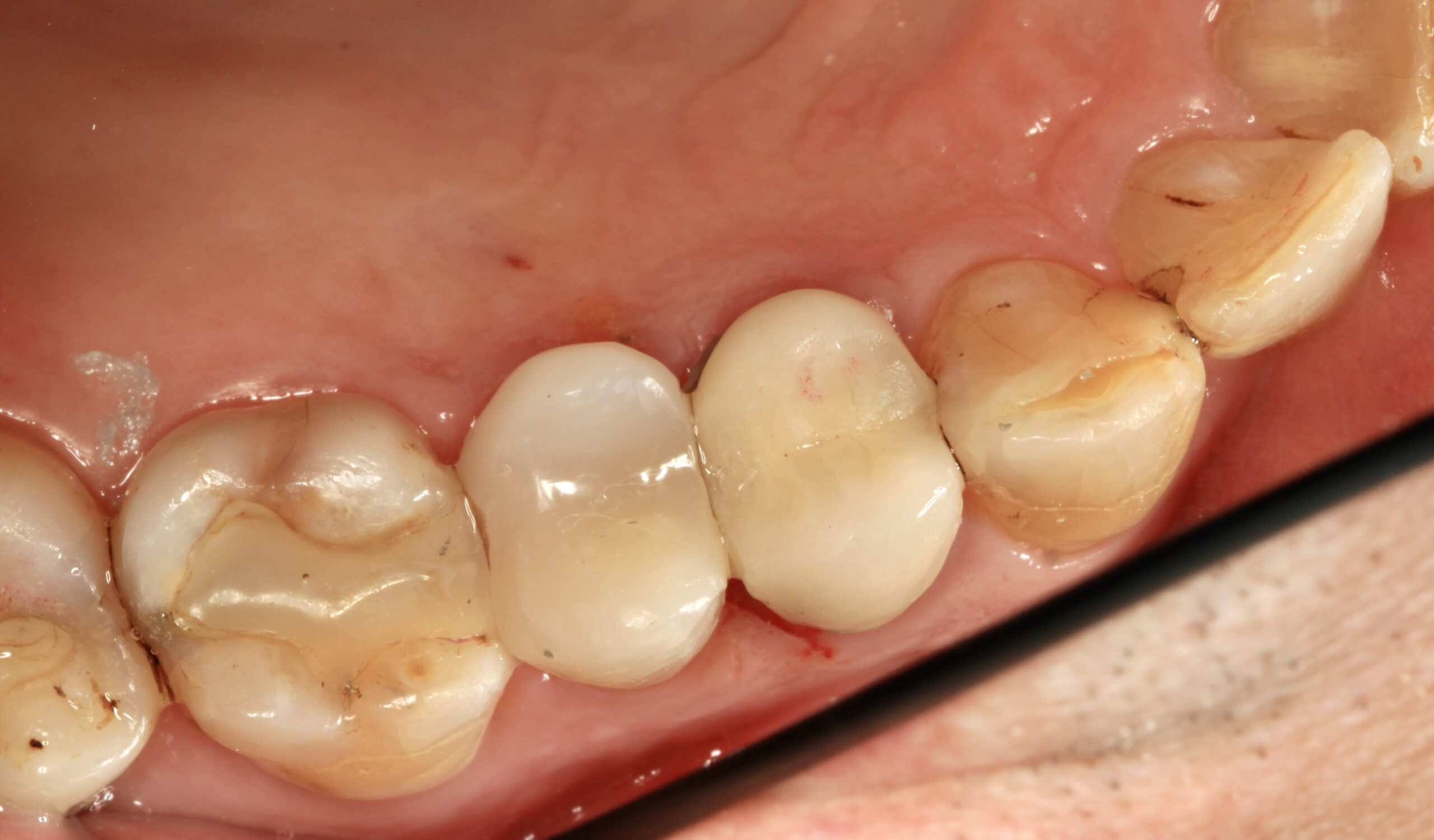 Bioclear
