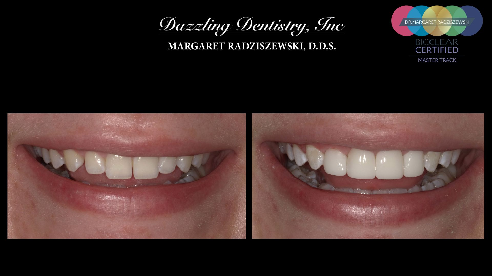 Bioclear