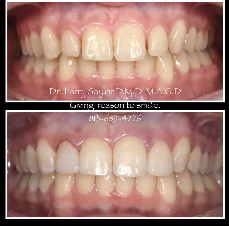 Bioclear