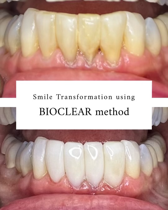 Bioclear