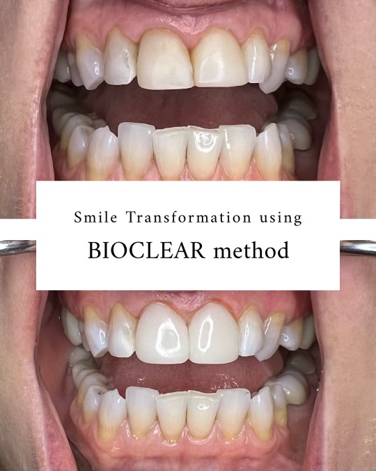 Bioclear