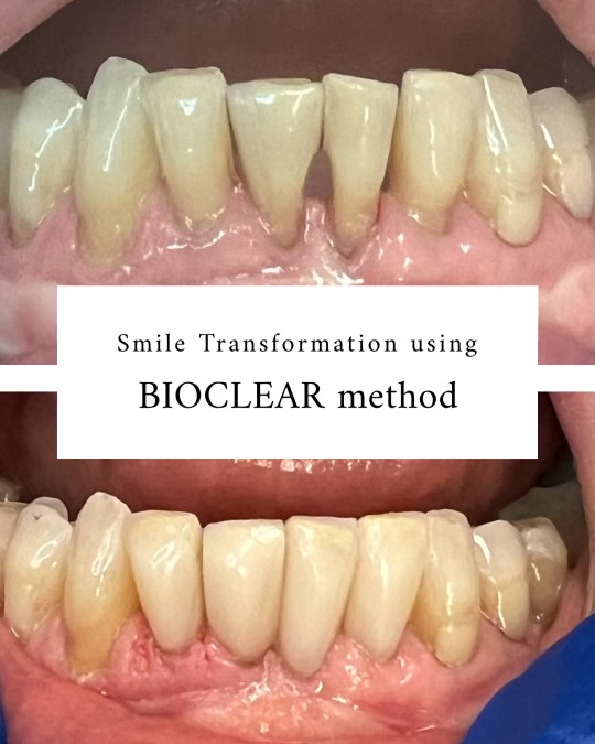 Bioclear
