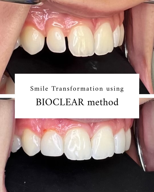 Bioclear
