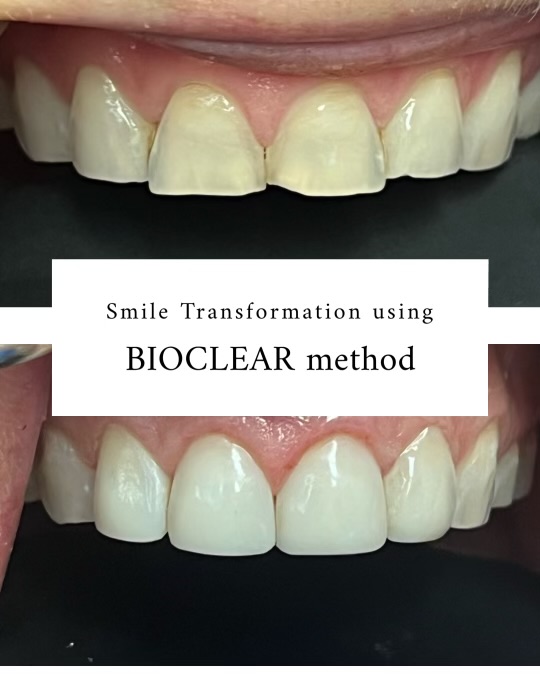 Bioclear