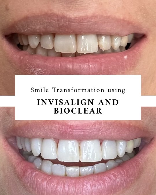 Bioclear