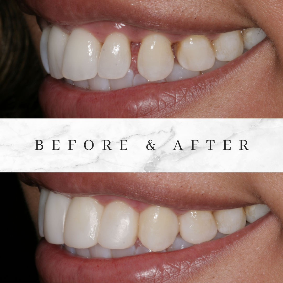 Bioclear