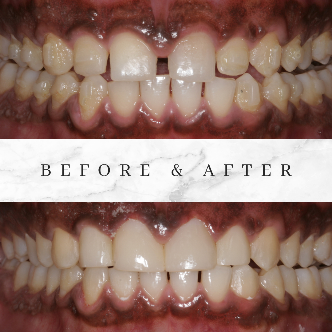 Bioclear