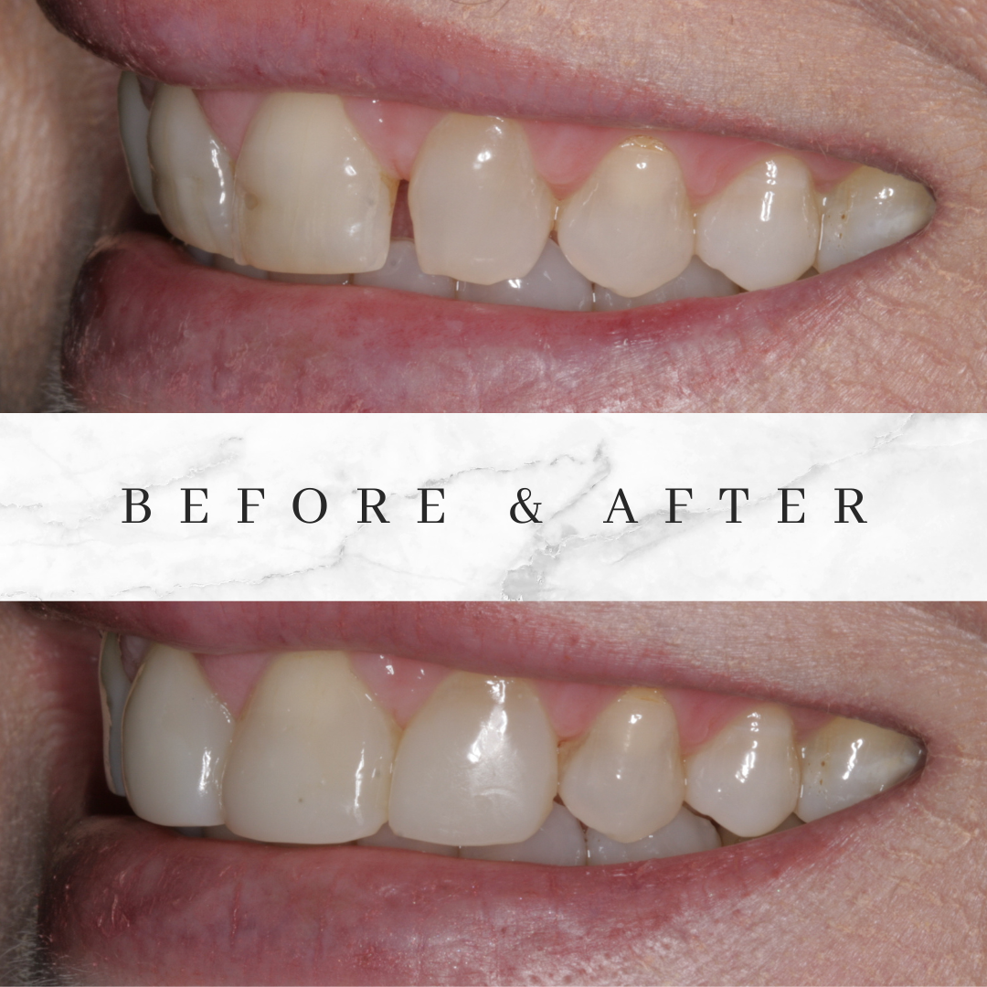 Bioclear