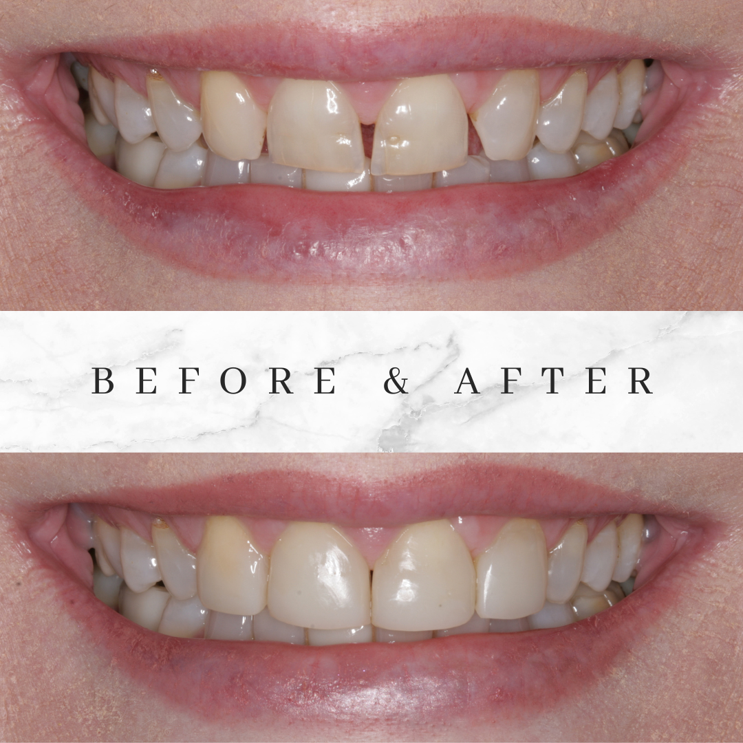 Bioclear