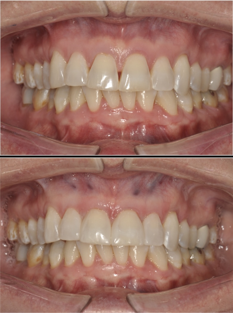 Bioclear