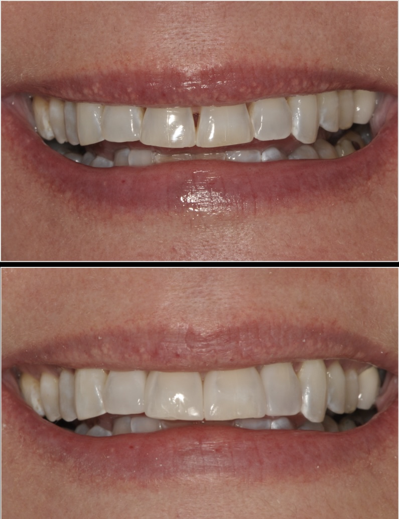 Bioclear