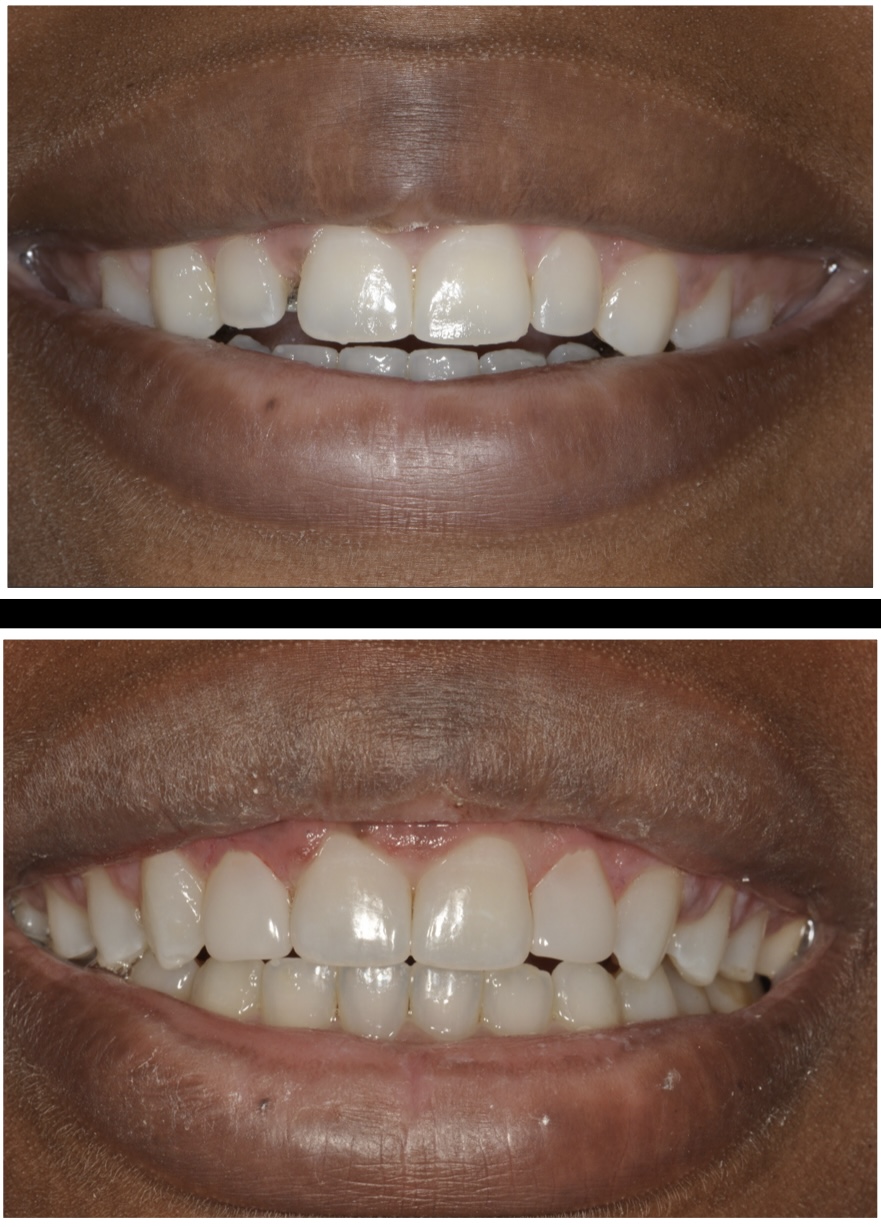 Bioclear