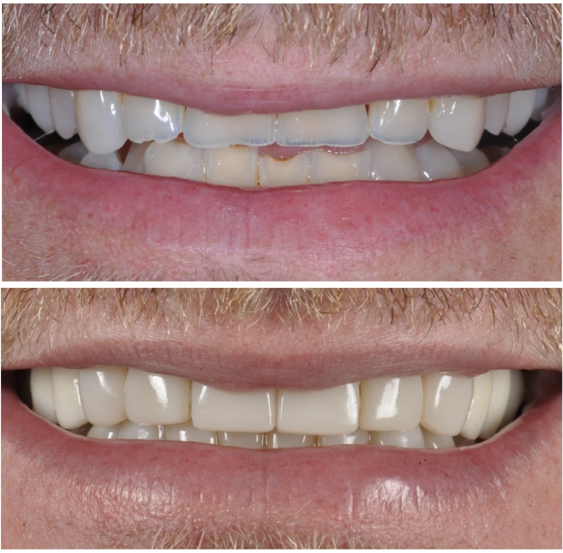 Bioclear