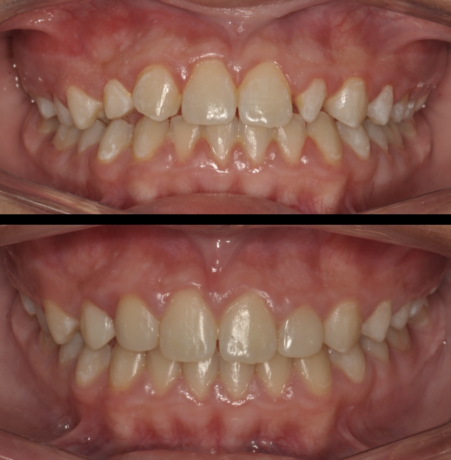Bioclear