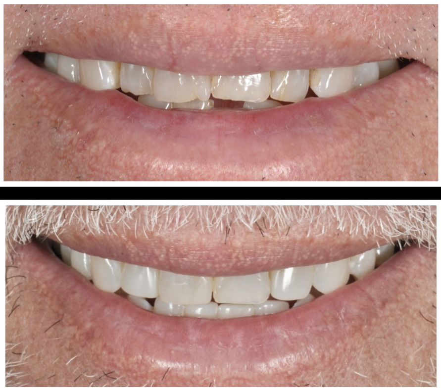 Bioclear