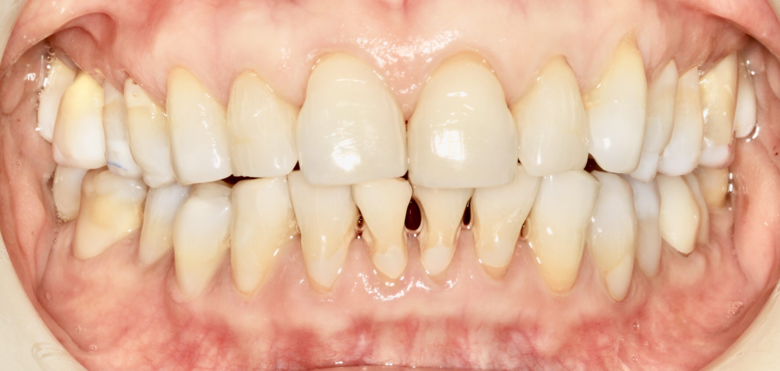 Bioclear